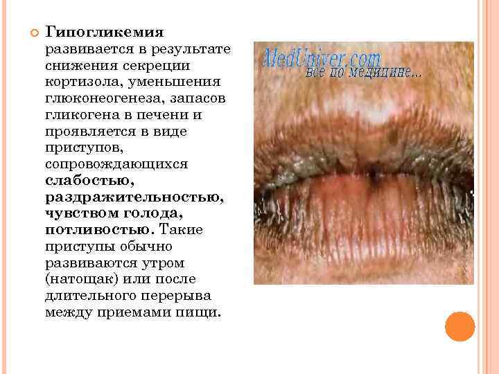  Гипогликемия развивается в результате снижения секреции кортизола, уменьшения глюконеогенеза, запасов гликогена в печени