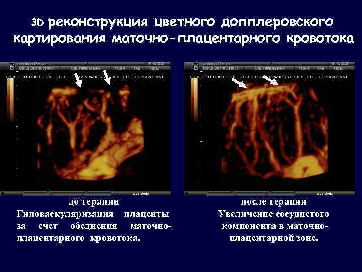 реконструкция цветного допплеровского картирования маточно-плацентарного кровотока 3 D до терапии Гиповаскуляризация плаценты за счет