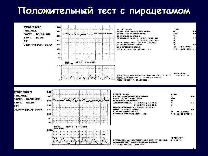 Положительный тест с пирацетамом 