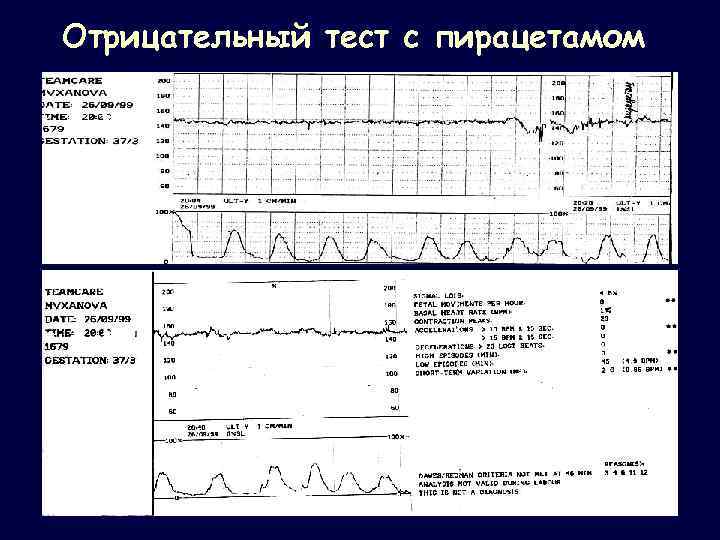 Отрицательный тест с пирацетамом 