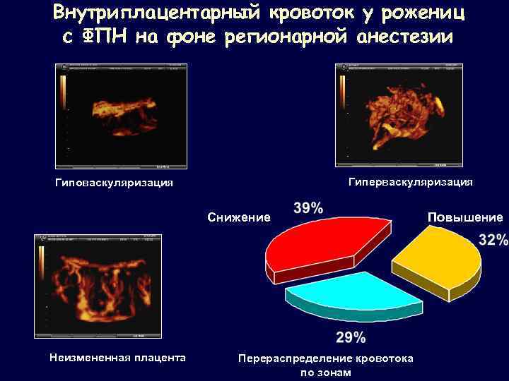 Внутриплацентарный кровоток у рожениц с ФПН на фоне регионарной анестезии Гиперваскуляризация Гиповаскуляризация Снижение Неизмененная