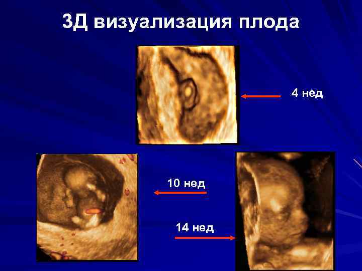 3 Д визуализация плода 4 нед 10 нед 14 нед 