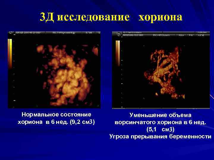 3 Д исследование хориона Нормальное состояние хориона в 6 нед. (9, 2 см )