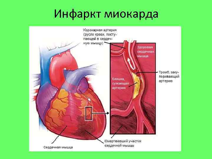 Инфаркт миокарда 