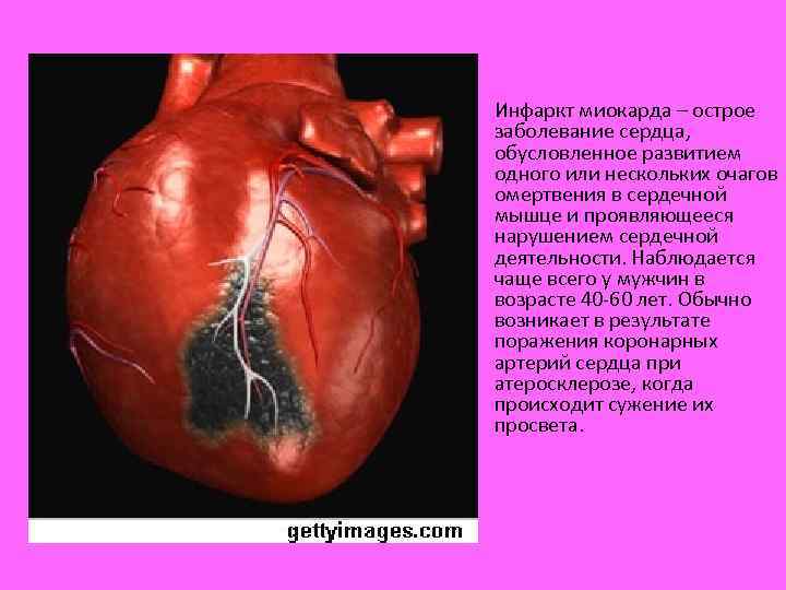  • Инфаркт миокарда – острое заболевание сердца, обусловленное развитием одного или нескольких очагов
