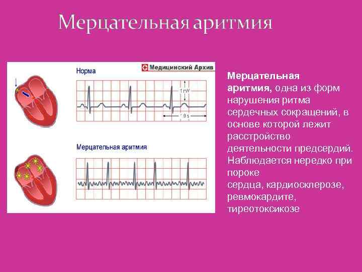 Мерцательная аритмия, одна из форм нарушения ритма сердечных сокращений, в основе которой лежит расстройство