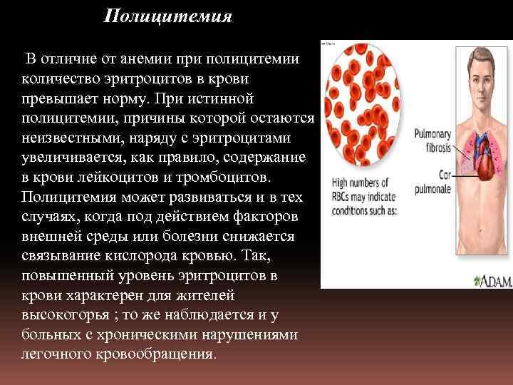 Полицитемия В отличие от анемии при полицитемии количество эритроцитов в крови превышает норму. При