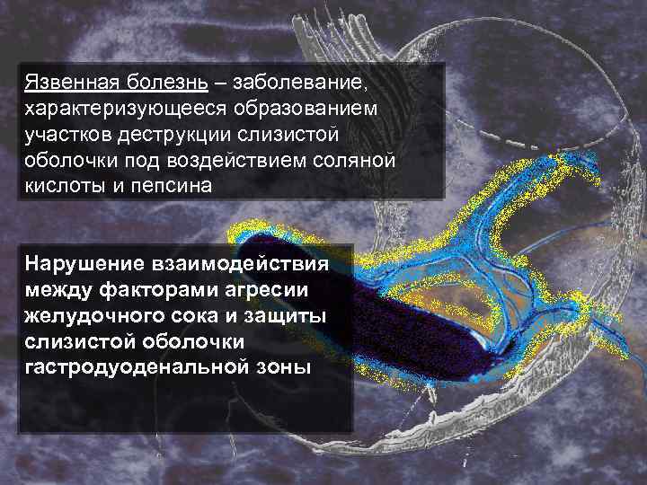 Язвенная болезнь – заболевание, характеризующееся образованием участков деструкции слизистой оболочки под воздействием соляной кислоты