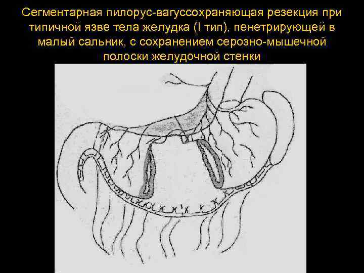 Сегментарная пилорус вагуссохраняющая резекция при типичной язве тела желудка (I тип), пенетрирующей в малый
