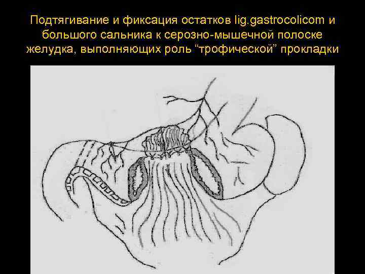 Подтягивание и фиксация остатков lig. gastrocolicom и большого сальника к серозно мышечной полоске желудка,