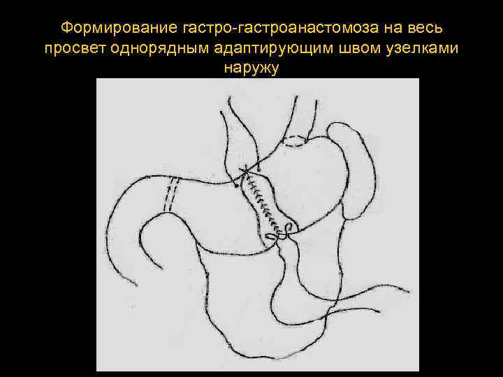 Формирование гастроанастомоза на весь просвет однорядным адаптирующим швом узелками наружу 