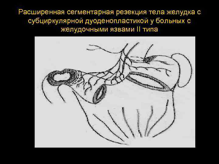 Расширенная сегментарная резекция тела желудка с субциркулярной дуоденопластикой у больных с желудочными язвами II
