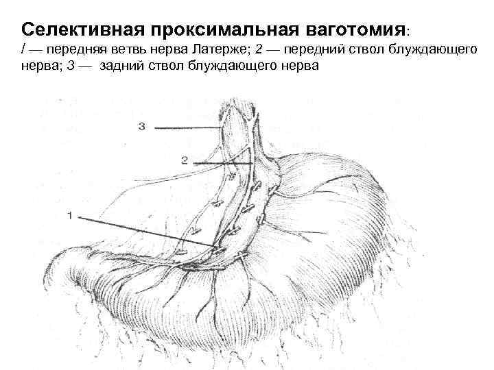 Селективная проксимальная ваготомия: / — передняя ветвь нерва Латерже; 2 — передний ствол блуждающего