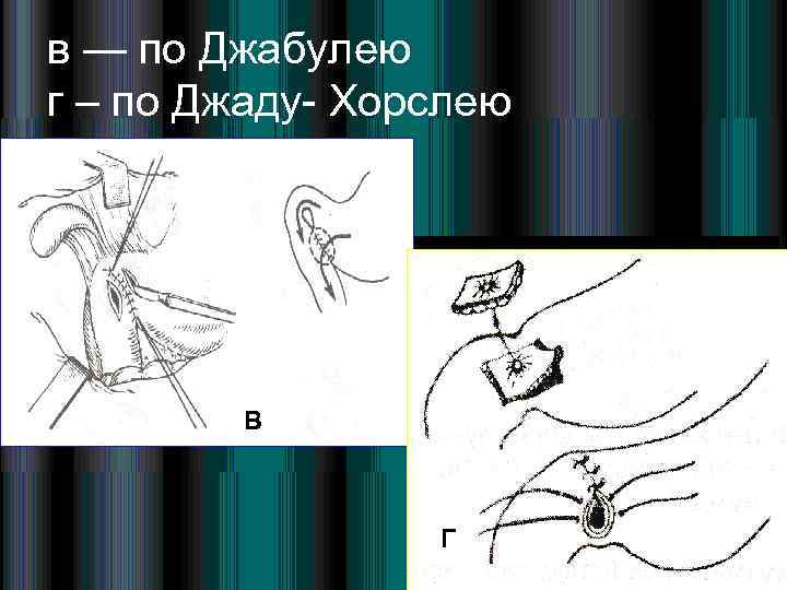 в — по Джабулею г – по Джаду Хорслею В Г 