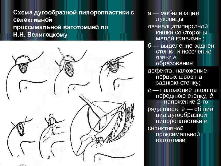 Пилоропластика по финнею схема