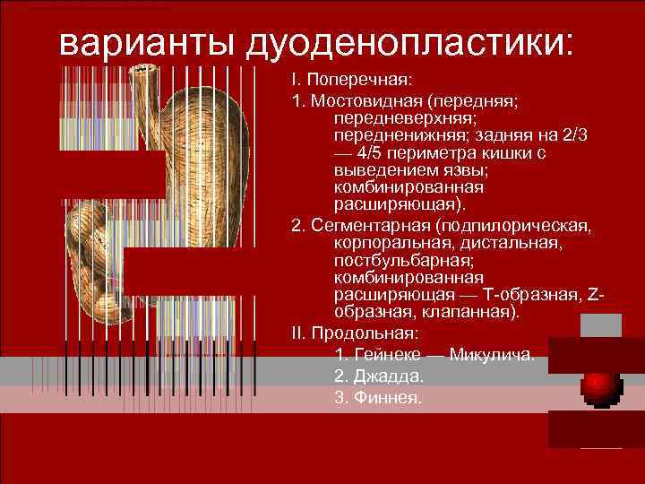 варианты дуоденопластики: I. Поперечная: 1. Мостовидная (передняя; передневерхняя; передненижняя; задняя на 2/3 — 4/5