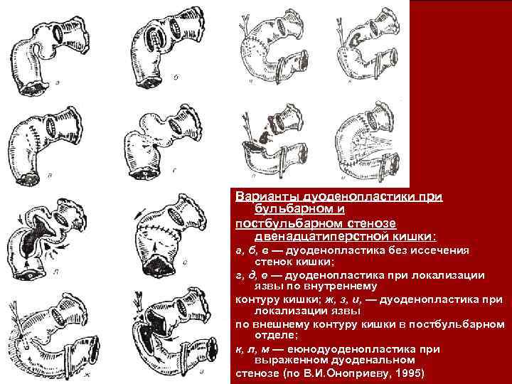 Варианты дуоденопластики при бульбарном и постбульбарном стенозе двенадцатиперстной кишки: а, б, в — дуоденопластика