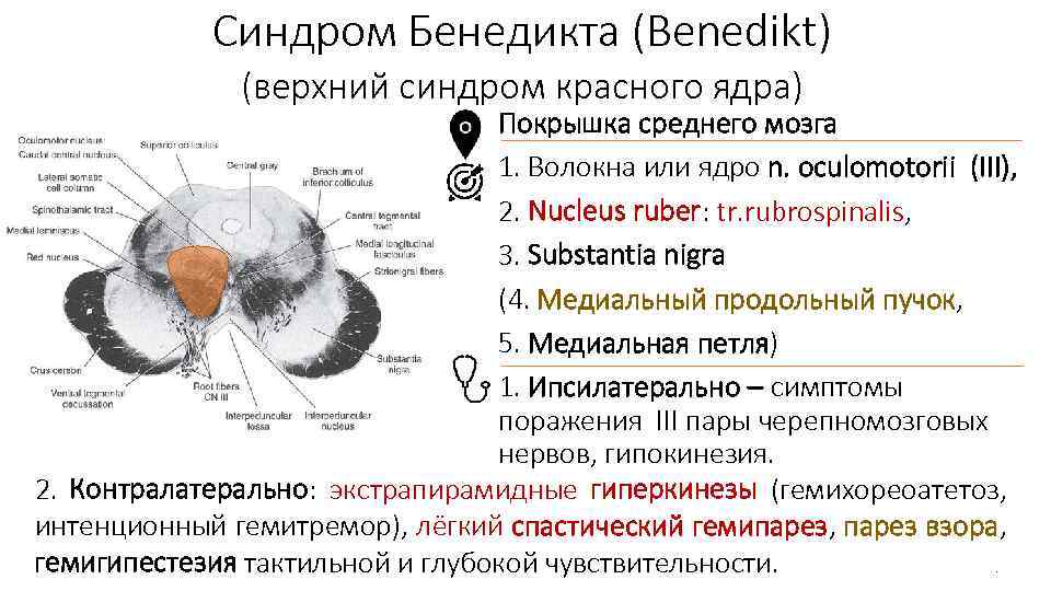 Синдром Бенедикта (Benedikt) (верхний синдром красного ядра) Покрышка среднего мозга 1. Волокна или ядро
