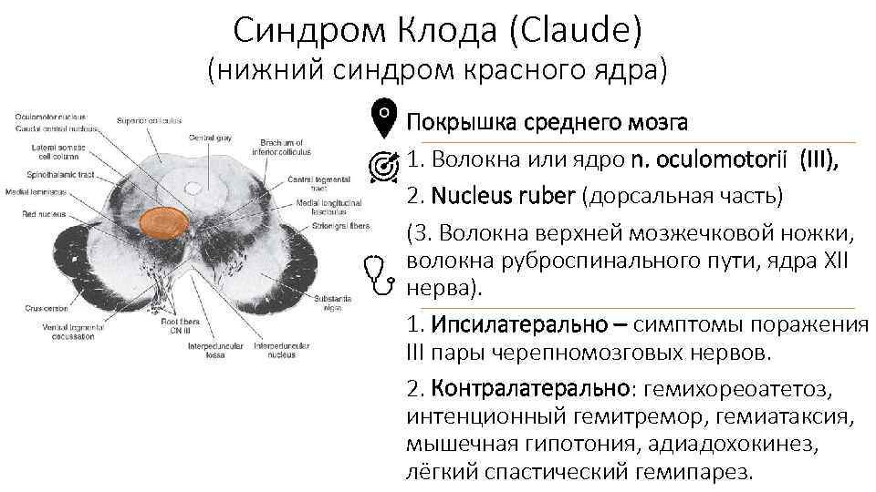 Синдром Клода (Claude) (нижний синдром красного ядра) Покрышка среднего мозга 1. Волокна или ядро