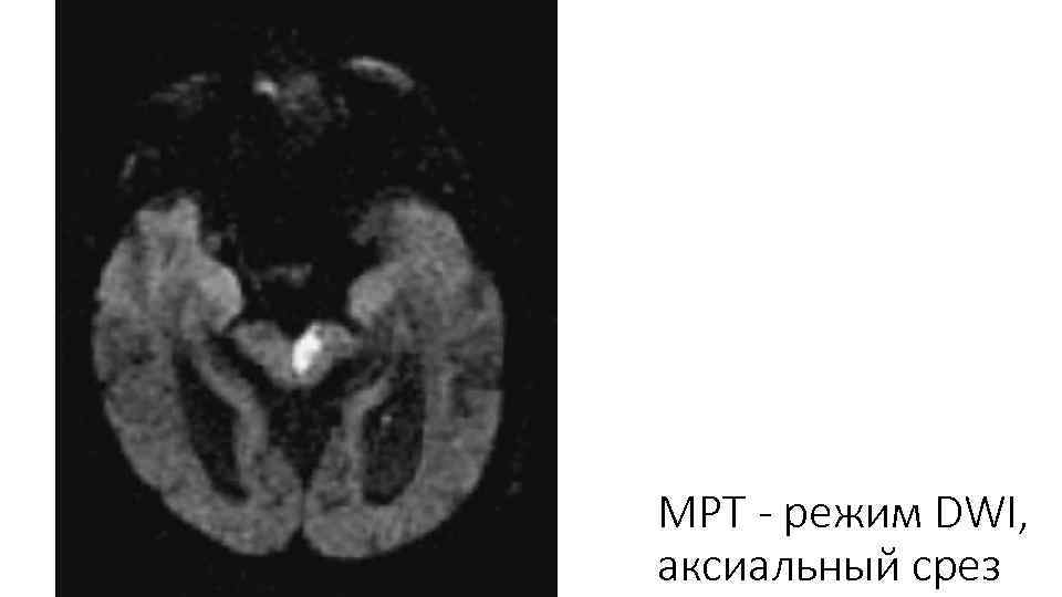 МРТ - режим DWI, аксиальный срез 
