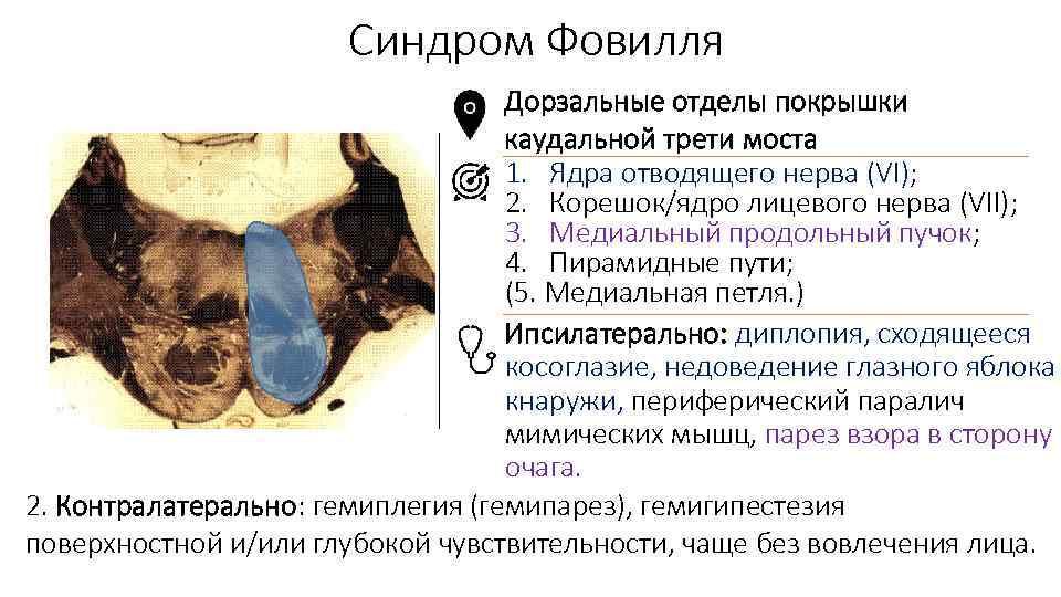 Синдром Фовилля Дорзальные отделы покрышки каудальной трети моста 1. Ядра отводящего нерва (VI); 2.