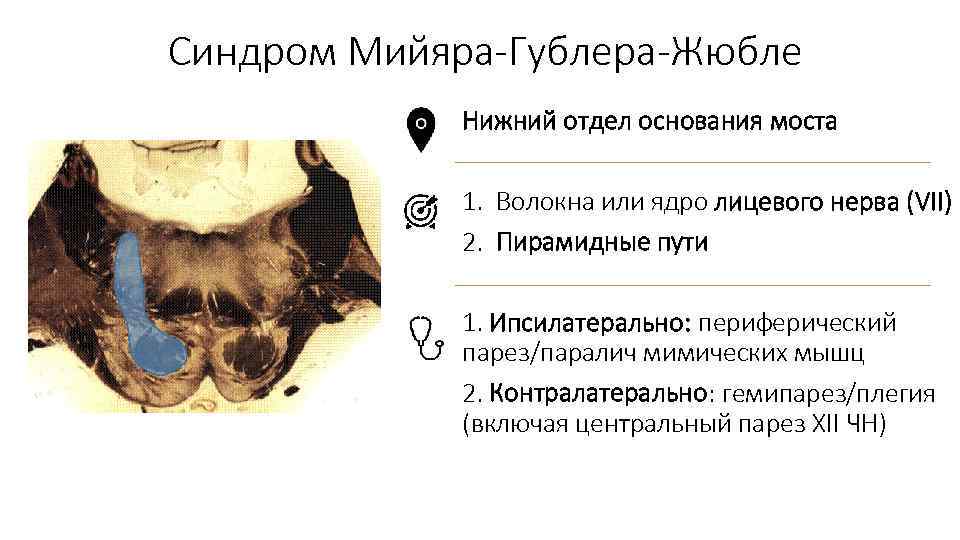 Синдром Мийяра-Гублера-Жюбле Нижний отдел основания моста 1. Волокна или ядро лицевого нерва (VII) 2.