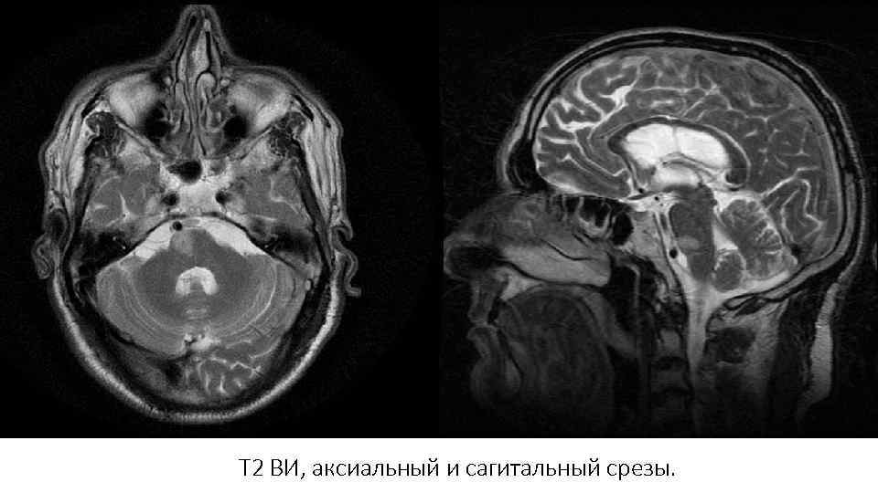 Т 2 ВИ, аксиальный и сагитальный срезы. 