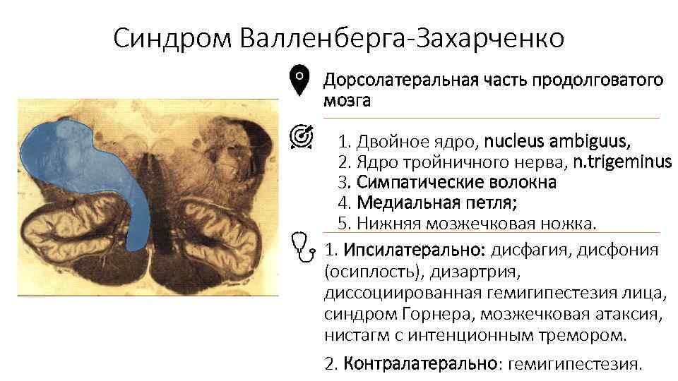 Синдром Валленберга-Захарченко Дорсолатеральная часть продолговатого мозга 1. Двойное ядро, nucleus ambiguus, 2. Ядро тройничного