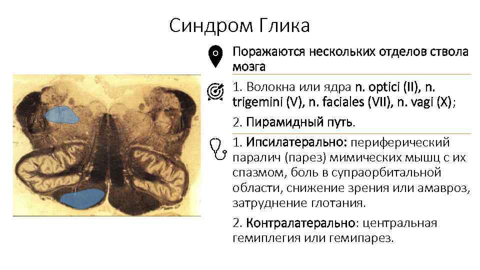 Синдром Глика Поражаются нескольких отделов ствола мозга 1. Волокна или ядра n. optici (II),