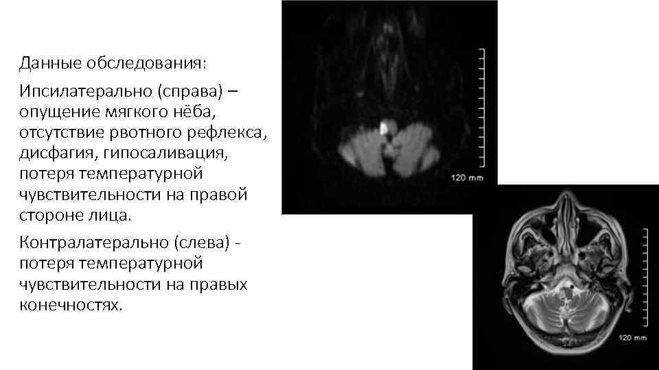 Данные обследования: Ипсилатерально (справа) – опущение мягкого нёба, отсутствие рвотного рефлекса, дисфагия, гипосаливация, потеря