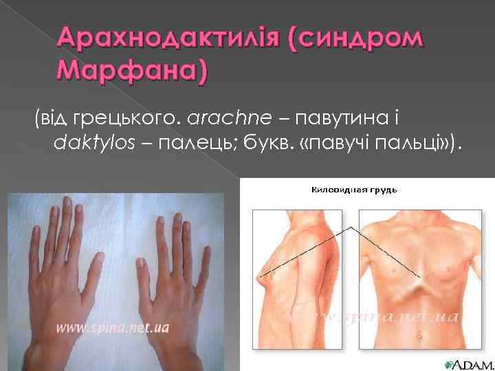 Арахнодактилія (синдром Марфана) (від грецького. arachne – павутина і daktylos – палець; букв. «павучі