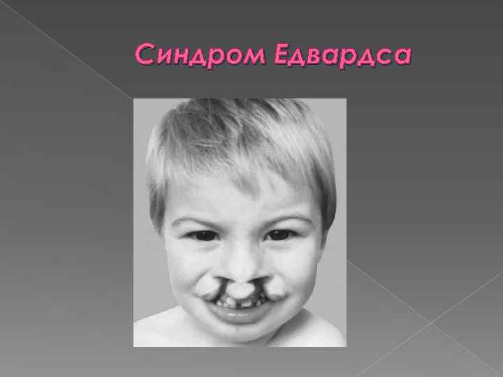 Синдром Едвардса 