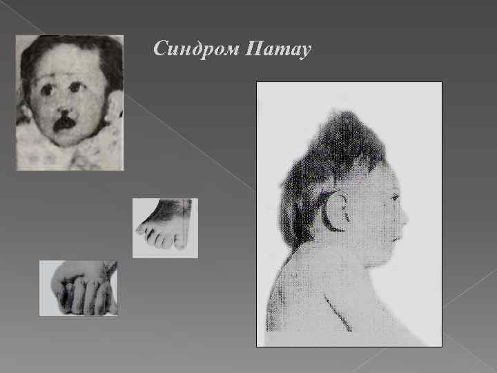 Синдром Патау 