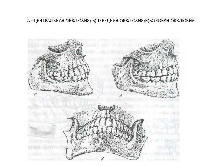 А –ЦЕНТРАЛЬНАЯ ОККЛЮЗИЯ; Б)ПЕРЕДНЯЯ ОККЛЮЗИЯ; В)БОКОВАЯ ОККЛЮЗИЯ 