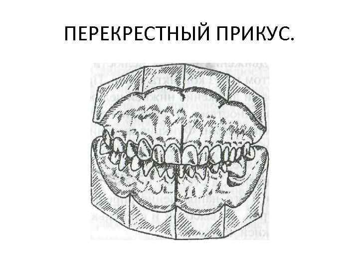 ПЕРЕКРЕСТНЫЙ ПРИКУС. 