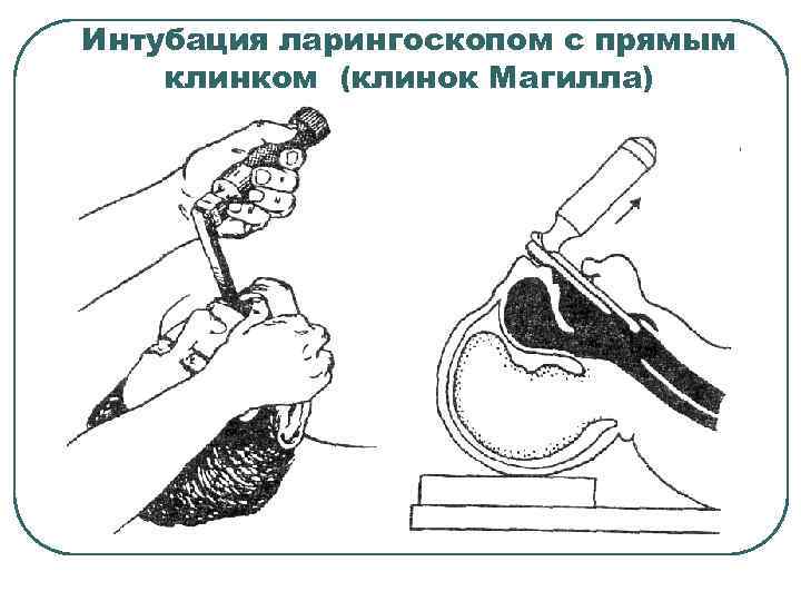 Интубация ларингоскопом с прямым клинком (клинок Магилла) 