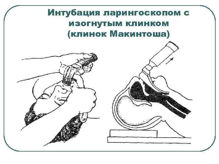 Интубация ларингоскопом с изогнутым клинком (клинок Макинтоша) 