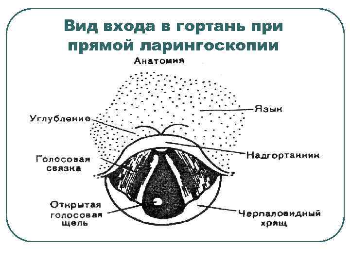 Вид входа в гортань при прямой ларингоскопии 