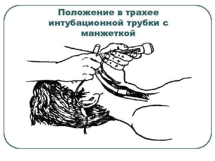 Положение в трахее интубационной трубки с манжеткой 