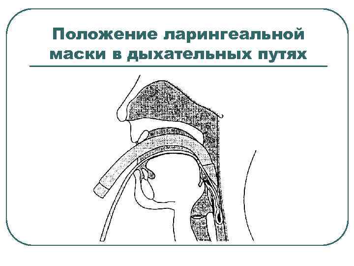 Положение ларингеальной маски в дыхательных путях 