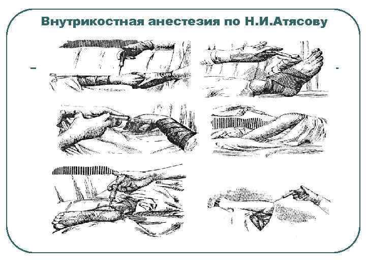 Внутрикостная анестезия по Н. И. Атясову 