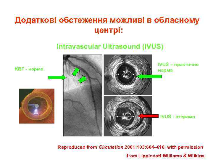 Додаткові обстеження можливі в обласному центрі: Intravascular Ultrasound (IVUS) КВГ норма IVUS – практично