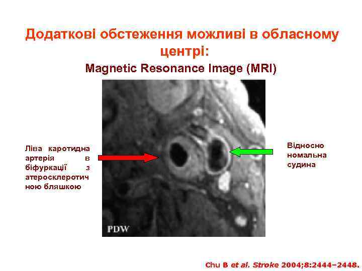 Додаткові обстеження можливі в обласному центрі: Magnetic Resonance Image (MRI) Ліва каротидна артерія в