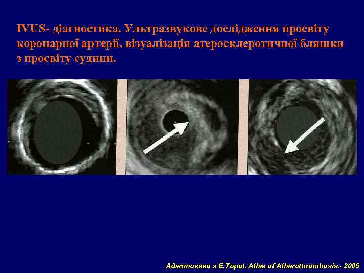 IVUS- діагностика. Ультразвукове дослідження просвіту коронарної артерії, візуалізація атеросклеротичної бляшки з просвіту судини. Адаптовано