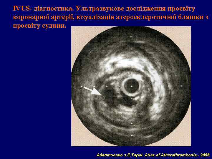 IVUS- діагностика. Ультразвукове дослідження просвіту коронарної артерії, візуалізація атеросклеротичної бляшки з просвіту судини. Адаптовано