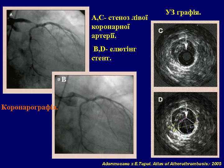 А, С- стеноз лівої коронарної артерії. УЗ графія. В, D- елютінг стент. В Коронарографія.