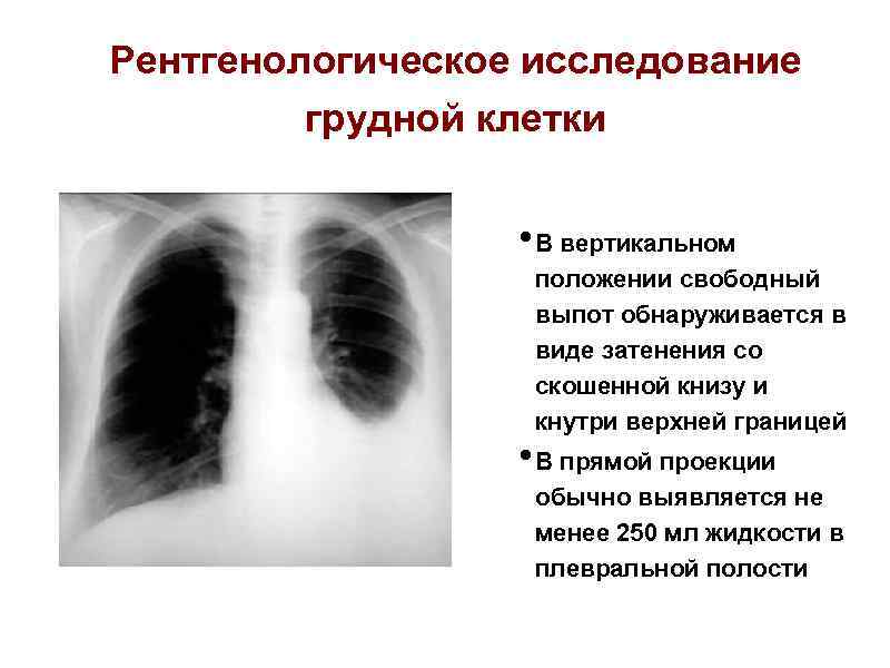 Рентгенологическое исследование грудной клетки • В вертикальном положении свободный выпот обнаруживается в виде затенения