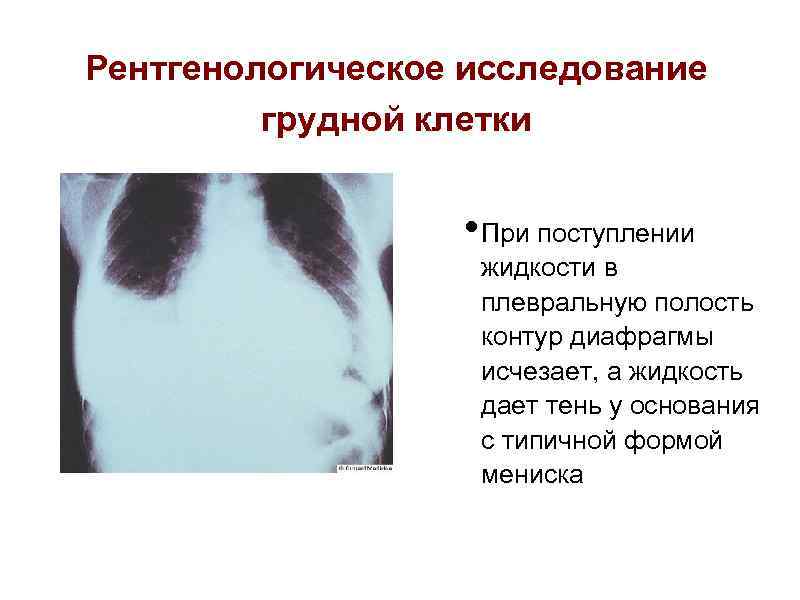 Рентгенологическое исследование грудной клетки • При поступлении жидкости в плевральную полость контур диафрагмы исчезает,