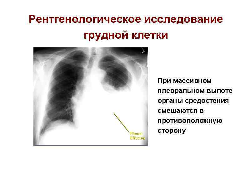 Рентгенологическое исследование грудной клетки При массивном плевральном выпоте органы средостения смещаются в противоположную сторону