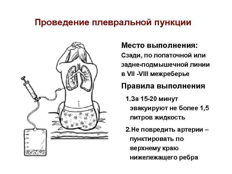 Проведение плевральной пункции Место выполнения: Сзади, по лопаточной или задне-подмышечной линии в VII -VIII